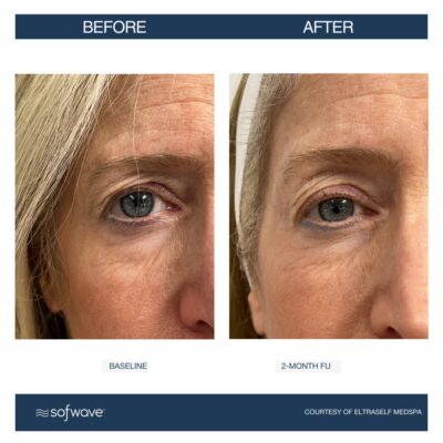 Sofwave Skin Tightening in Buffalo, NY | Revitalize Your Skin Today